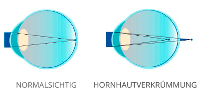 Astigmatismus